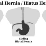 hiatal-hernia-हाईटल.jpg-