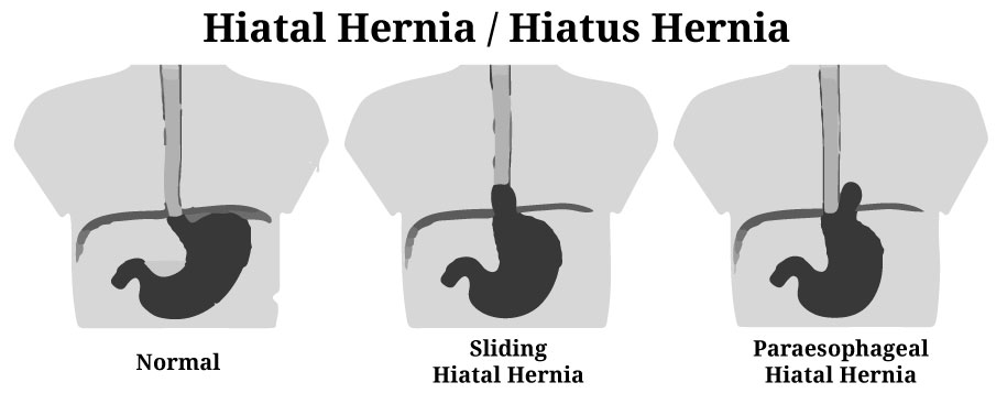 Hiatal hernia in hindi, Hiatus hernia in hindi