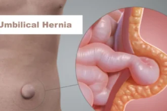 Umbilical Hernia, अंबिलिकल हर्निया